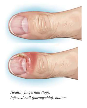 Nail Infection (Paronychia) Nail Infection (Paronychia)